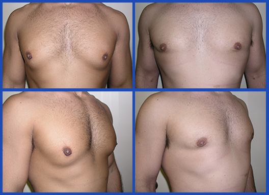🥇 Massage After Gynecomastia Surgery/Man Boobs Removal